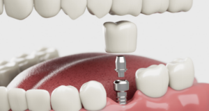 Single Dental Implants
