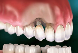 Dental Implant issue